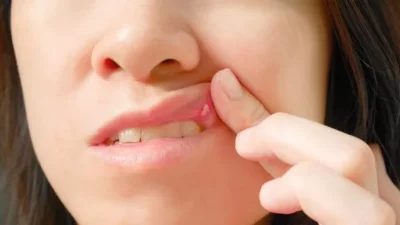 Ağız Yarasına Ne İyi Gelir? Nasıl İyileşir? Ağız sağlığı, beden sağlığımız ile doğrudan bağlantılıdır. Yazımızda, ağız yarası