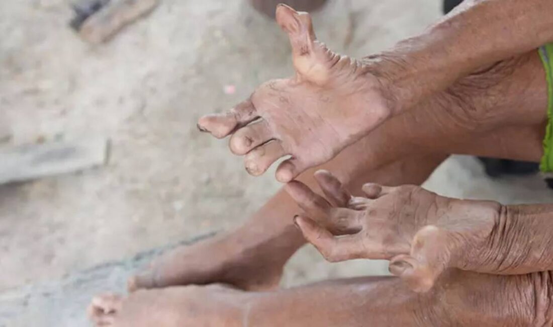 Avrupa kıtası, modern tıp ve sağlık altyapısının gelişmesiyle birçok bulaşıcı