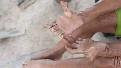 Avrupa kıtası, modern tıp ve sağlık altyapısının gelişmesiyle birçok bulaşıcı