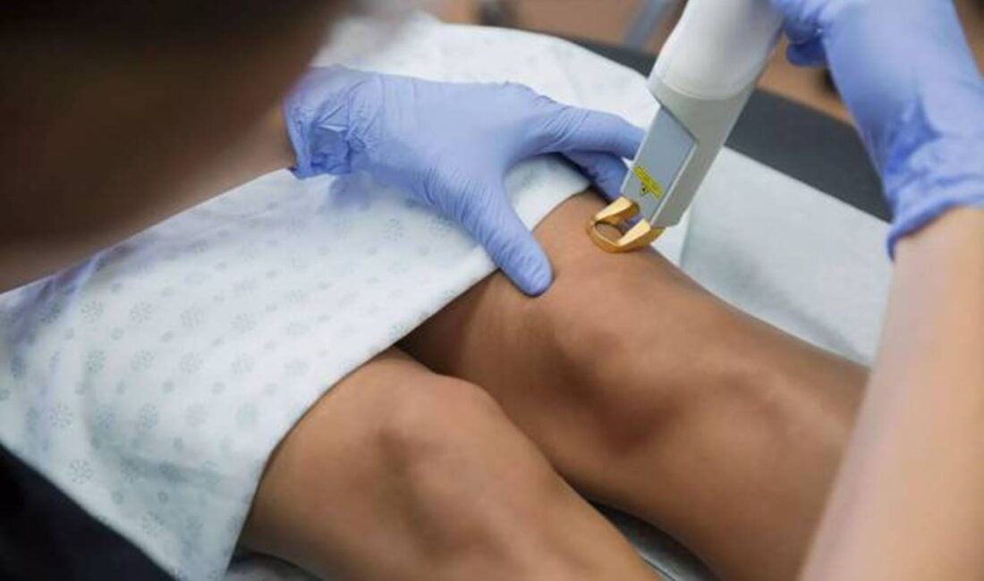 Birçok Kişi Bu Hatayı Yapıyor: Varis Ağrısı Neden Artıyor? Varis kaynaklı bacak ağrıları, özellikle günün ilerleyen saatlerinde artarak kişilerin