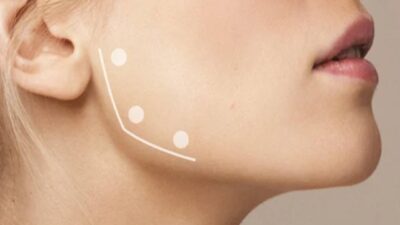 Son yıllarda hem estetik hem de fonksiyonel faydalarıyla öne çıkan