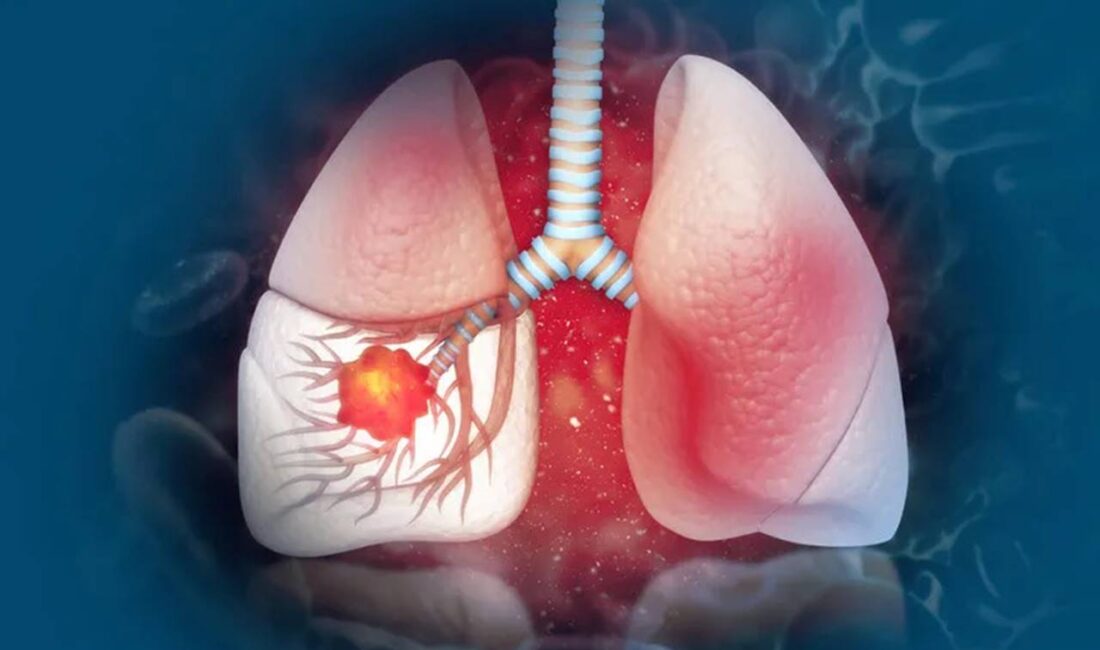 Dünyada en yaygın görülen kanser türlerinden biri olan akciğer kanseri,