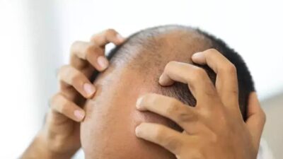 Son yıllarda erkek tipi saç dökülmesi (androgenetik alopesi) tedavisinde kayda