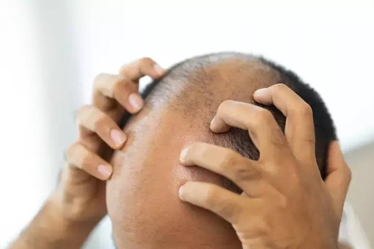 Son yıllarda erkek tipi saç dökülmesi (androgenetik alopesi) tedavisinde kayda