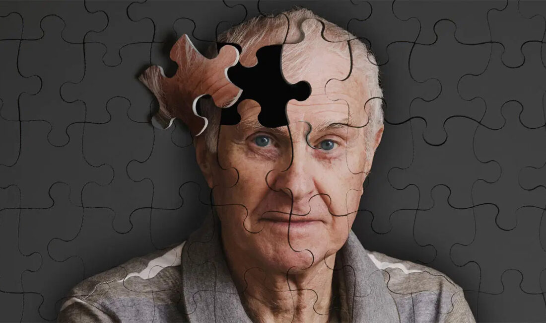 Alzheimer hastalığı, günümüz tıbbının çözülmesi en zor problemlerinden biri olmayı