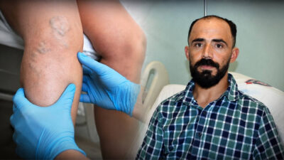 Kahramanmaraş'ta karın ağrısıyla hastaneye başvuran 33 yaşındaki Yusuf Baynal'ın sedef
